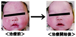 アトピー性皮膚炎