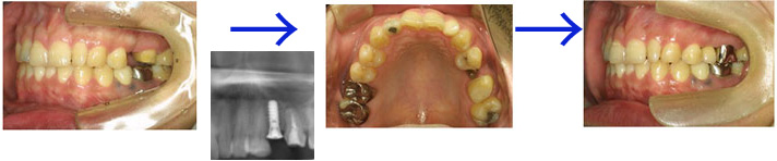 インプラント症例