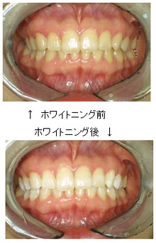 ホワイトニング