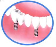 インプラント治療